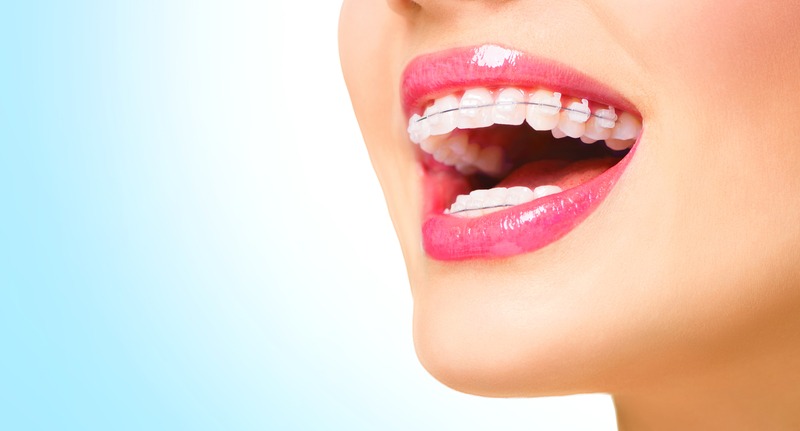 Webp.nTips for Maintaining a Beautiful Smile Braceset-resizeimage-61-5cf2ce47