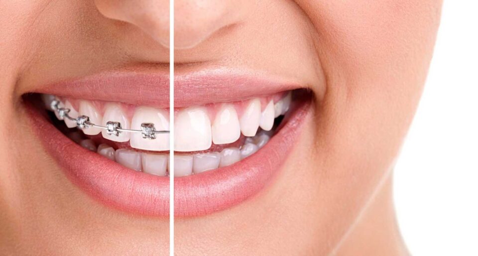 afterThe Best Ways to Maintain Healthy Teeth After Braces Treatment-braces-are-removed-2d764a7a